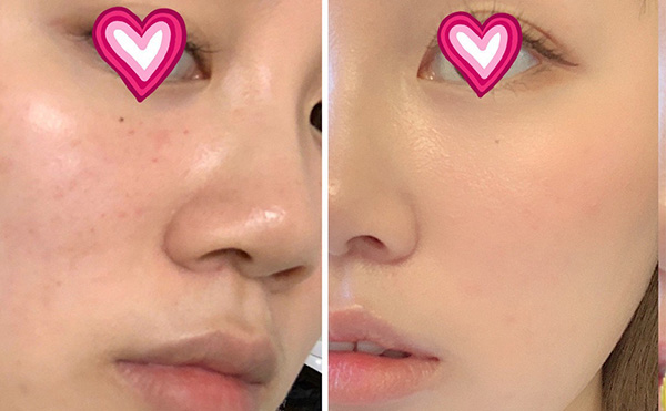 水光針多少錢(qián)?價(jià)格受哪些因素影響?