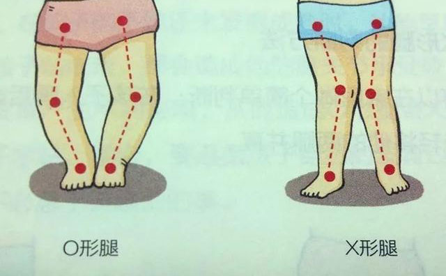 羅圈腿怎樣矯正？羅圈腿手術(shù)矯正多少錢？