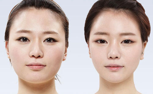 顴骨整形要多少錢(qián)？