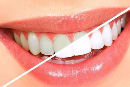 做牙冠多少錢一顆？