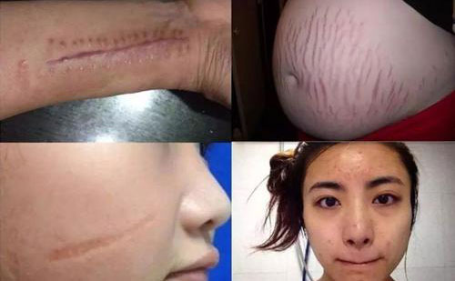 疤痕修復(fù)手術(shù)一般多少錢？