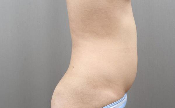 腹部吸脂手術(shù)價(jià)格是多少？腹部吸脂手術(shù)的副作用？