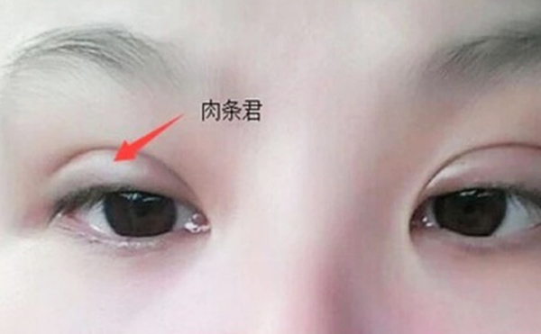 雙眼皮不自然怎么補(bǔ)救？雙眼皮肉條好修復(fù)么？