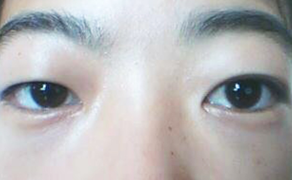 間歇性眼球突出是什么意思?眼球突出矯正費用受什么影響?