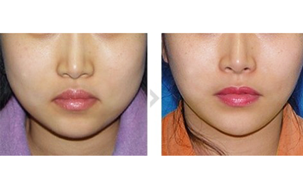 超聲波面部吸脂多少錢？