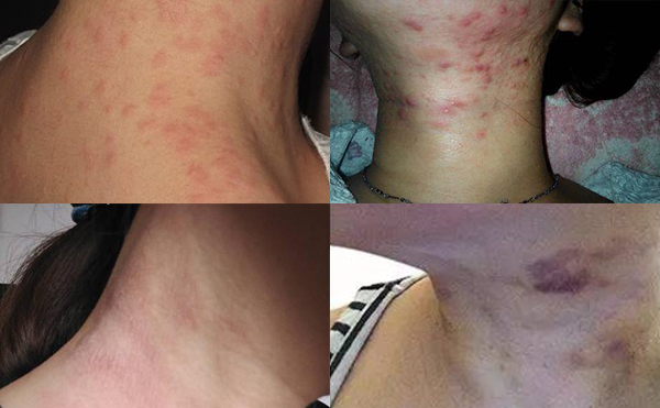 嗨體去頸紋有什么副作用？