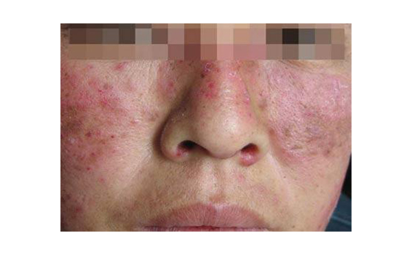 復(fù)合彩光會(huì)出現(xiàn)副作用嗎？