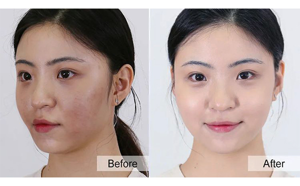 美白針有什么優(yōu)勢？