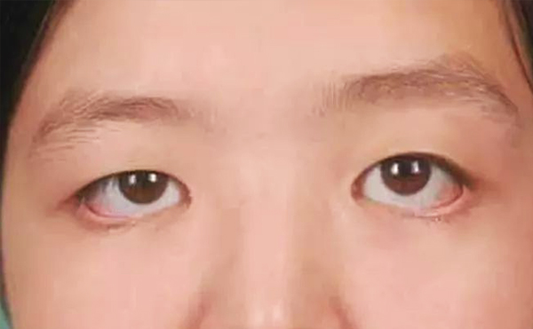 眼袋修復一般多少錢?眼袋修復術后怎么護理?