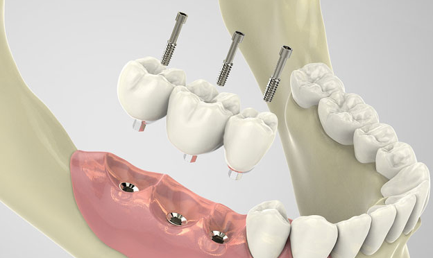 種植牙多少錢一顆牙？
