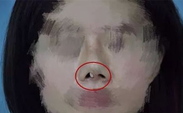 隆鼻假體取出后怎么做可以盡快恢復原樣?