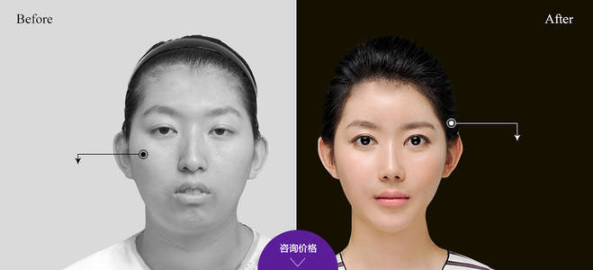 下頜角整形的方法有哪些？