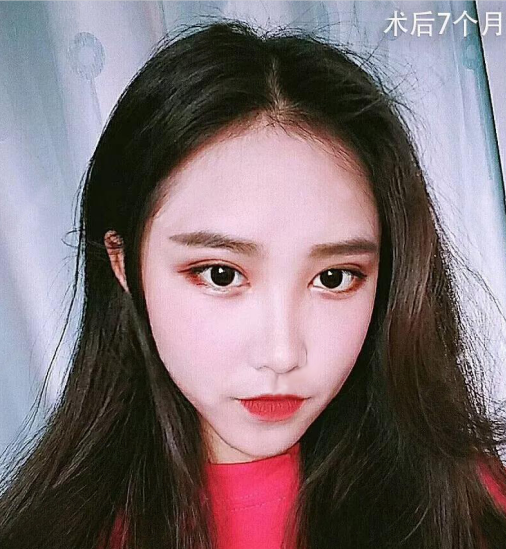 微創(chuàng)雙眼皮術后七個月效果