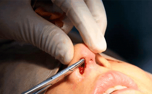 在原來的假體上，可不可以重新調(diào)整或者更換一下?