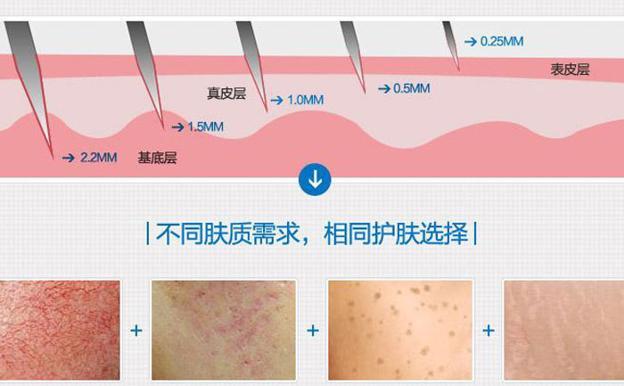 微針去痘坑多少錢一次？