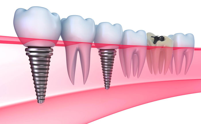 牙齒種植大概費用是多少？牙齒種植多少錢一顆