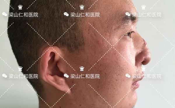 鼻再造手術(shù)效果怎么樣?