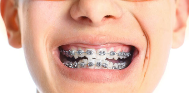 牙齒矯正的最好方法是什么？