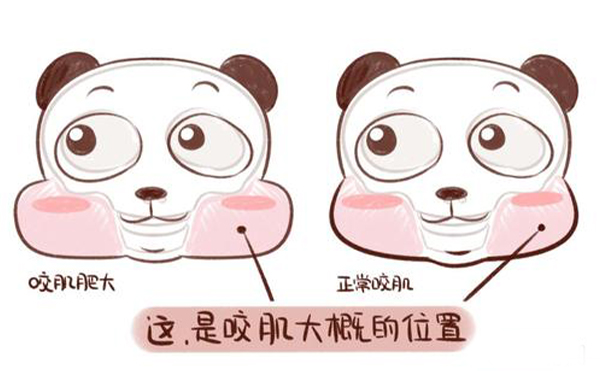 造成咬肌肥大的原因是什么？