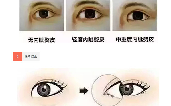 單眼皮可以只開眼角嗎?效果怎么樣?