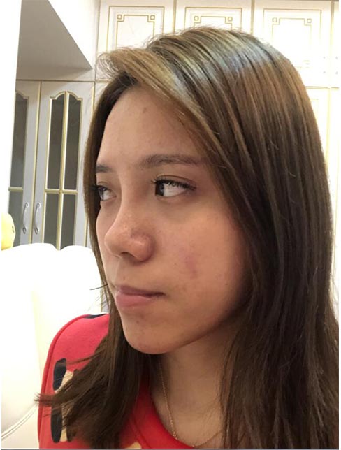 肋軟骨鼻綜合案例：術前效果