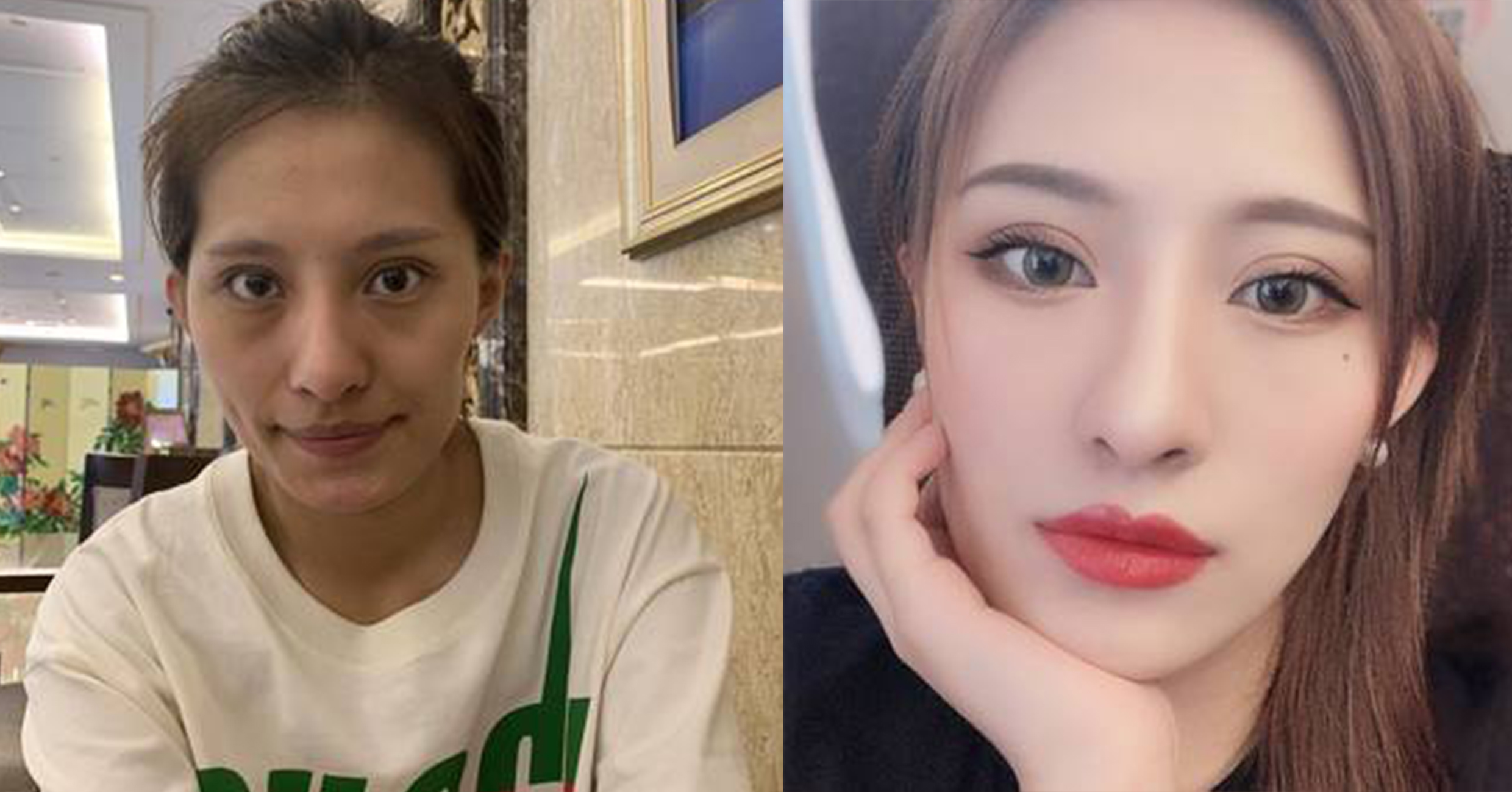 脂肪填充手術(shù)效果對比1