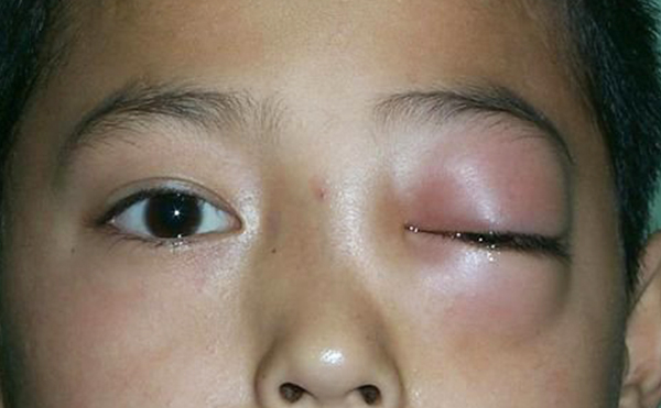 單側(cè)眼球突出什么原因?矯正需要多少錢?