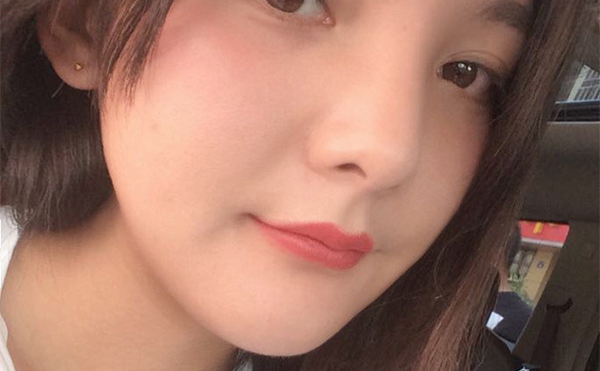 石家莊藍山杜建龍醫(yī)生下頜角整容手術(shù)案例術(shù)后三個月