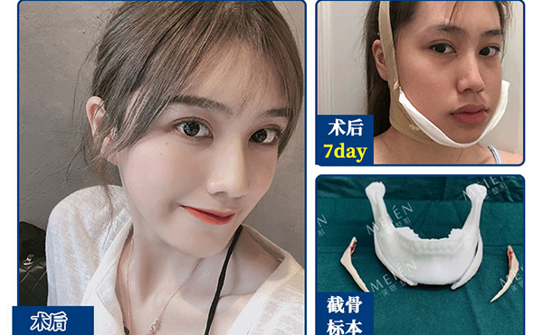 下頜角整形手術有風險嗎?有什么風險?