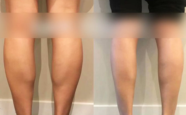 打瘦腿針是怎么操作的？