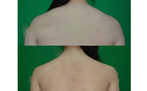 背部吸脂手術(shù)前要注意什么？