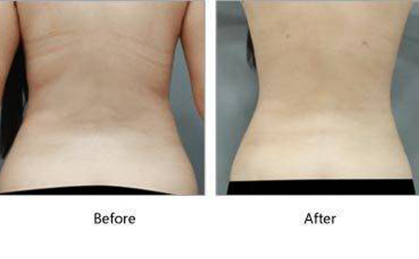 吸脂瘦背部多少錢？