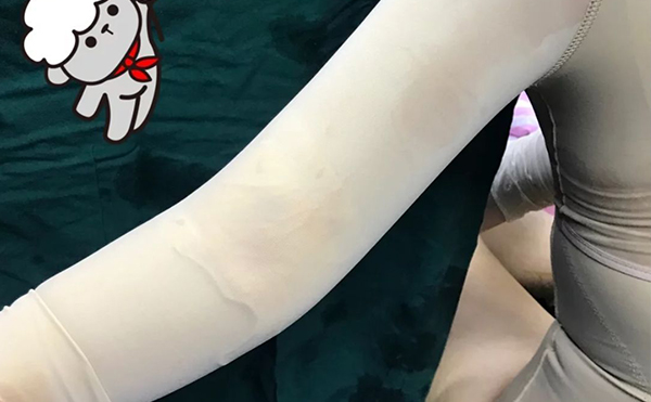 超聲波吸脂瘦手臂安全嗎？