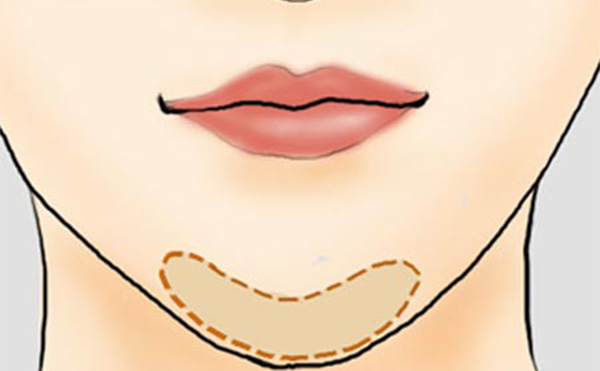 一般哪些類型的下巴會被建議做下巴整形?