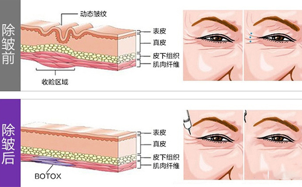 注射除皺安全嗎?哪些人不能打?