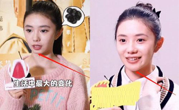 玻尿酸隆下巴整形攻略【優(yōu)勢、適宜人群、注意事項】