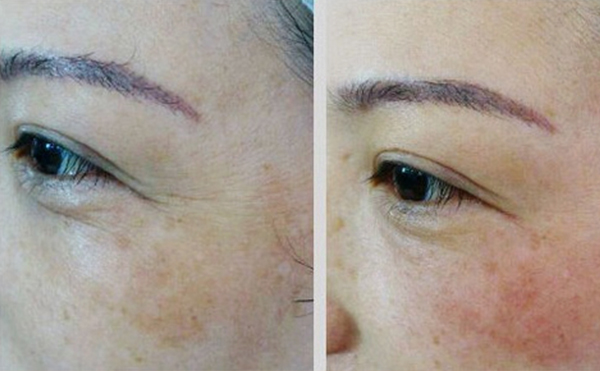 魚尾紋除皺哪些方法好？