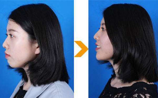 可以用肋軟骨來(lái)隆下巴嗎?什么材料隆下巴比較好?