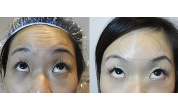 玻尿酸能去抬頭紋嗎？