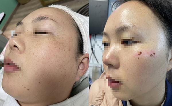 彩光嫩膚有沒有副作用？