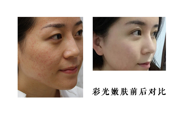 皮膚薄能做彩光嫩膚嗎？