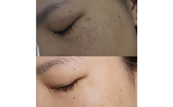 激光美白能維持多久？