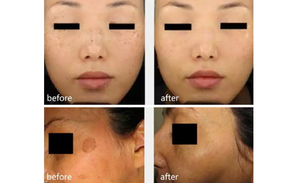 【術(shù)前必看】哪些斑能去除?哪些斑不容易去除?