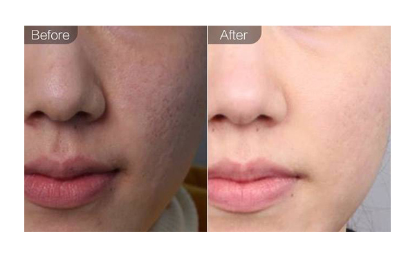 e光嫩膚適合哪些人？