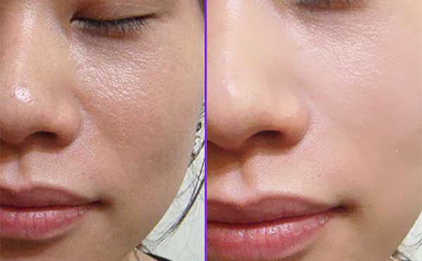 做e光嫩膚前要注意什么？