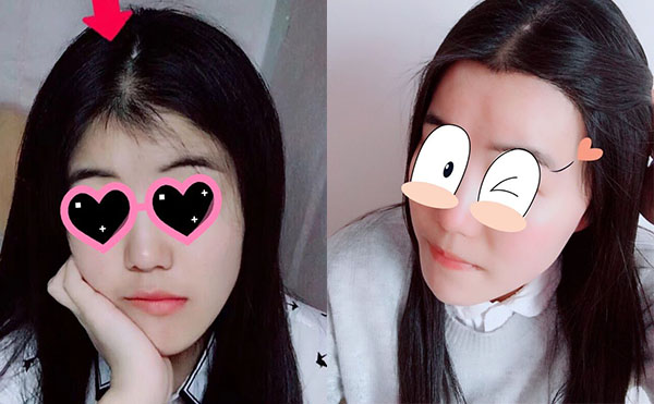 冰點(diǎn)脫毛發(fā)際線怎么樣？