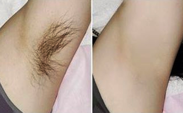 光子脫腋毛有什么優(yōu)勢？