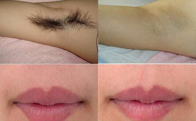 冰點(diǎn)脫毛大概多少錢？