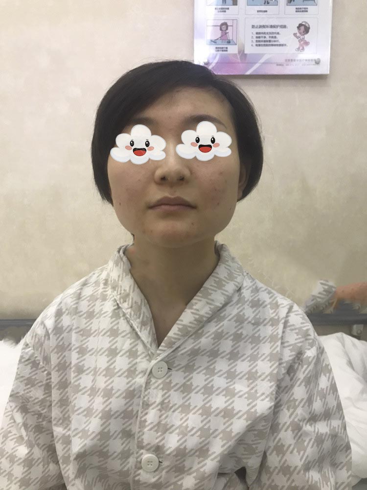 下頜角整形效果