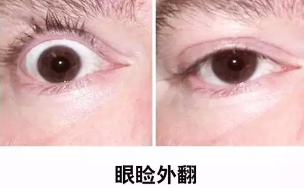 醫(yī)美技術(shù)越來越發(fā)達(dá)，不少愛美的人本著變美的心情滿懷期待地去做雙眼皮、開眼角等項目，不料整容不成、反倒毀容，后悔也來不及。有些做雙眼皮的姑娘術(shù)后出現(xiàn)眼瞼外翻的情況，那眼瞼外翻是什么意思?上眼瞼外翻如何修復(fù)?